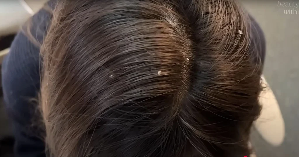 فروة رأس جافة وعلاماتها الشائعة
